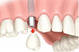 Металлокерамическая коронка (металлокерамика) на имплантате (одна единица) Металлокерамическая коронка (металлокерамика) на имплантате (одна единица)